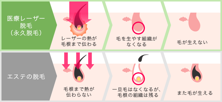 エステ脱毛と医療脱毛の違い